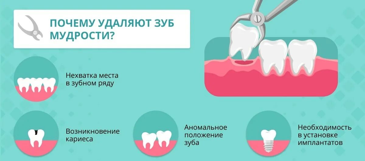 Можно ли поставить зуб после удаления. Удалённый зуб мудрости. удаленные зубы мудрости.