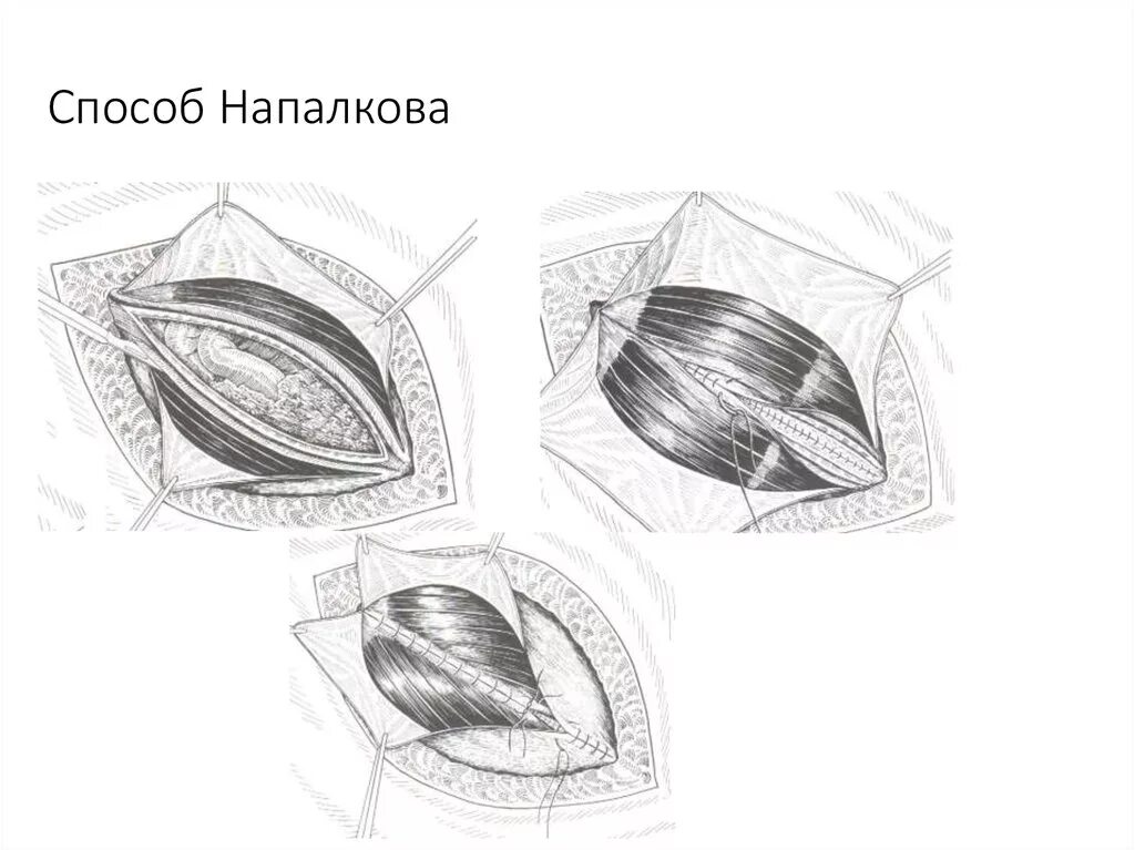 Операция грыжа белой. Метод напалкова белой линии живота. пластика грыжи по напалкову. метод напалкова грыжи белой линии.