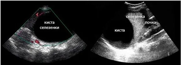Паразитарная киста селезенки УЗИ. Миелолипома селезенки УЗИ. Ультразвуковое исследование (УЗИ) селезенки. Селезенка топография УЗИ.