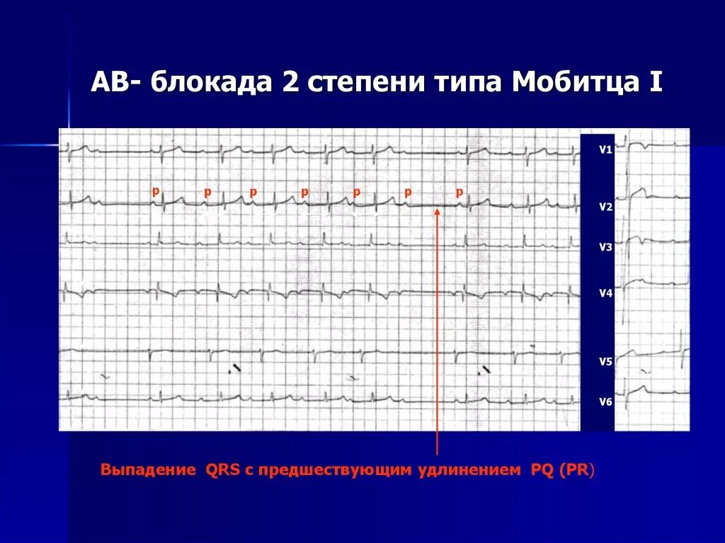 Полная поперечная блокада сердца экг. Блокада сердца первой степени симптомы. Аритмии и блокады сердца атлас электрокардиограмм. А-в блокада 2 степени 1 типа на экг. Полная поперечная блокада на экг.