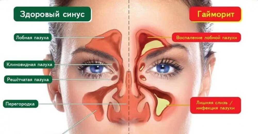 Вывод мокроты из организма. Где скапливаются сопли. Вазомоторный риносинусит. Скапливание соплей в носоглотке. Где скапливаются сопли.