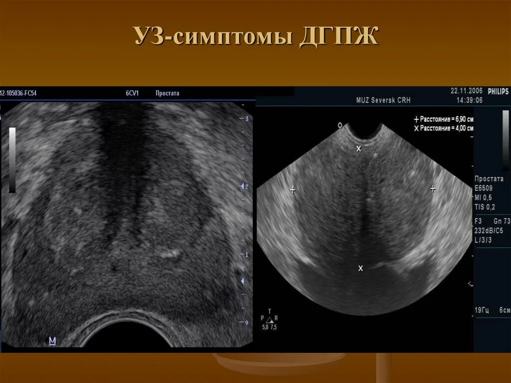 Дгпж узи. Аденома предстательной железы на УЗИ. УЗИ доброкачественная гиперплазия предстательной железы.