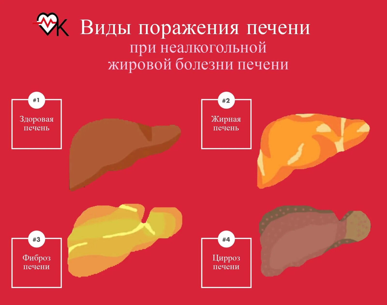 жировая дистрофия печени (стеатоз печени). воспаление печени заболевание. признаки проблем с печенью. изменения печени у беременных. печень проблемы симптомы.