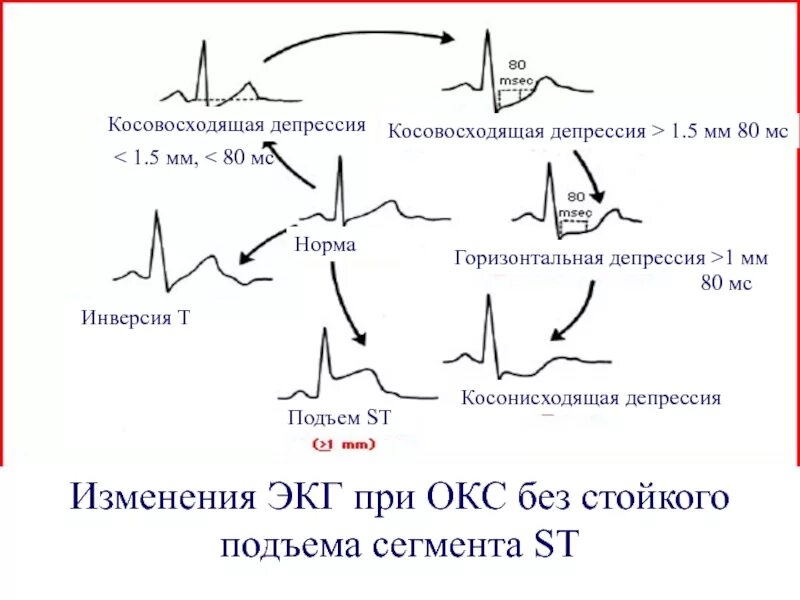 Эпизод депрессии st. Депрессия на ЭКГ при Окс в 1. Косовосходящая элевация сегмента St на ЭКГ. Депрессия сегмента St на ЭКГ. Элевация и депрессия сегмента St на ЭКГ.