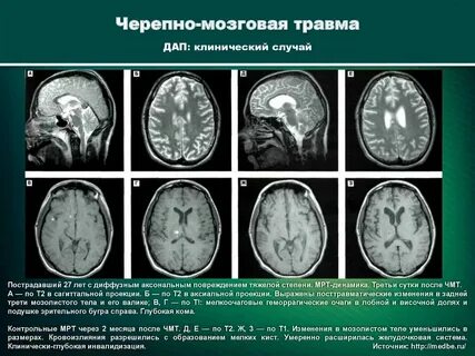 Код мкб черепно мозговая травма