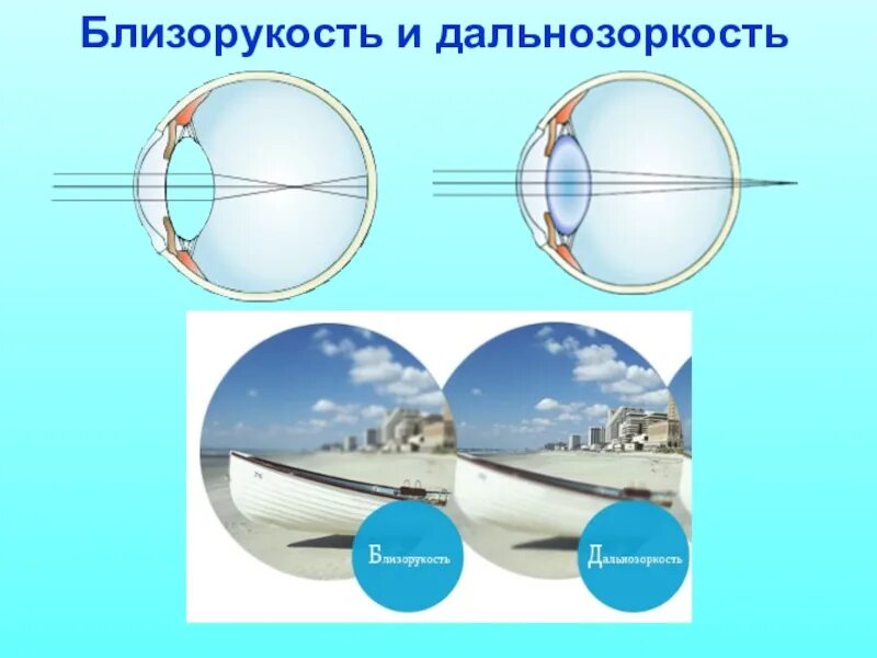 Миша страдает близорукостью а его брат дальнозоркостью. Близорукость. Миопия и гиперметропия. Близорукость или дальнозоркость. Близорукость и дальнозоркость разница.