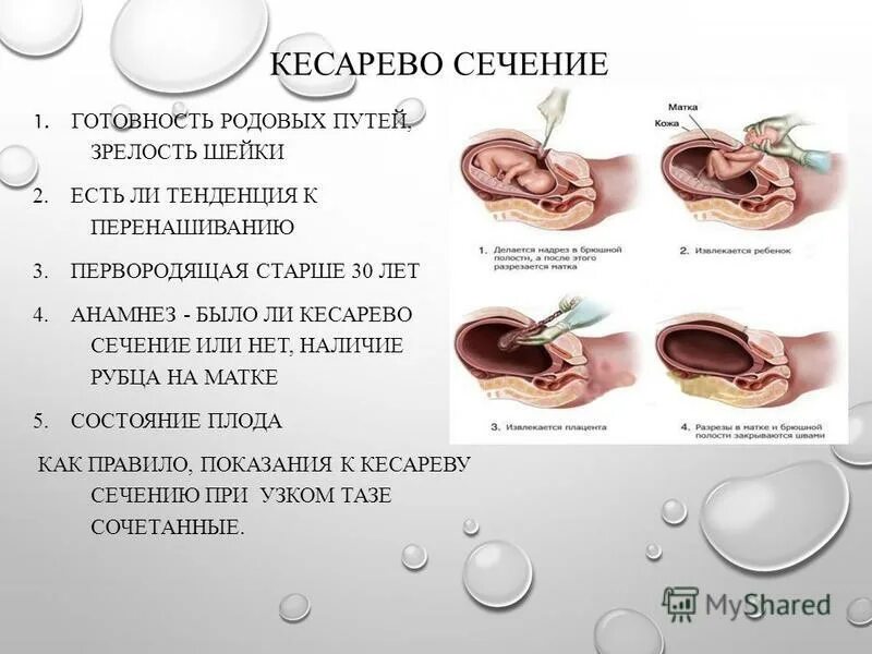 Кесарево узкий таз