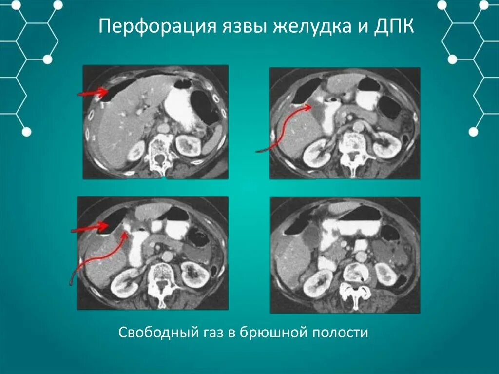 Перфоративная язва желудка Абдоминальные. Язва кт