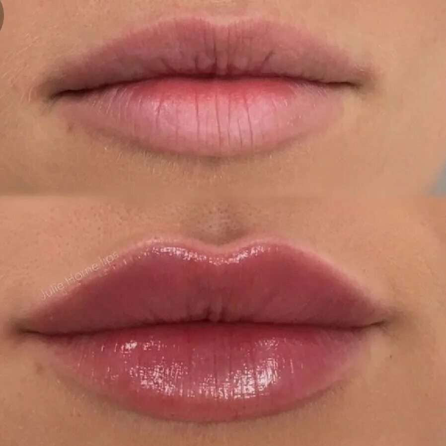 Зажившие губы после 1 мл филлера. Ботокс губ 1 мл. Красивое увеличение губ. Увеличение губ гиалуроновой кислотой. Контурная пластика губ до и после.