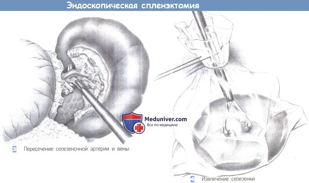 Спленэктомия что это. Этапы операции спленэктомии. Спленэктомия селезенки этапы. Спленэктомия ход операции. Спленэктомия Оперативная хирургия.