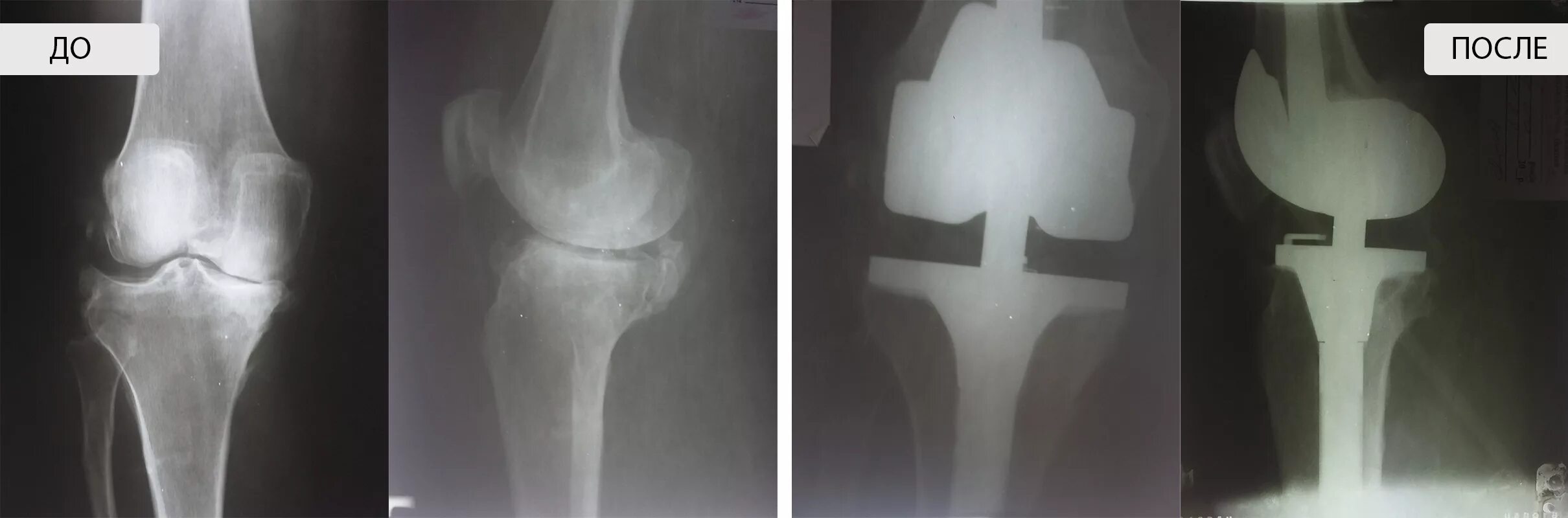Повреждение коленного сустава 3 степени. Гонартроз 2 степени рентген. Гонартроз коленного сустава 2 стадии рентген. Деформирующий артроз коленного сустава рентген.