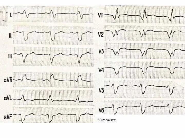 Диффузные изменения экг что это значит. ЭКГ при диффузных изменениях миокарда. Диффузно дистрофические изменения миокарда левого желудочка ЭКГ. Диффузное поражение миокарда ЭКГ. Диффузный фиброз миокарда ЭКГ.