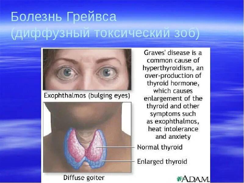 Диффузно токсический зоб грейвса. Диффузный токсический зоб( болезнь грейвса-базедова). болезнь грейвса (гипертиреоз). грейвса болезнь грейвса.