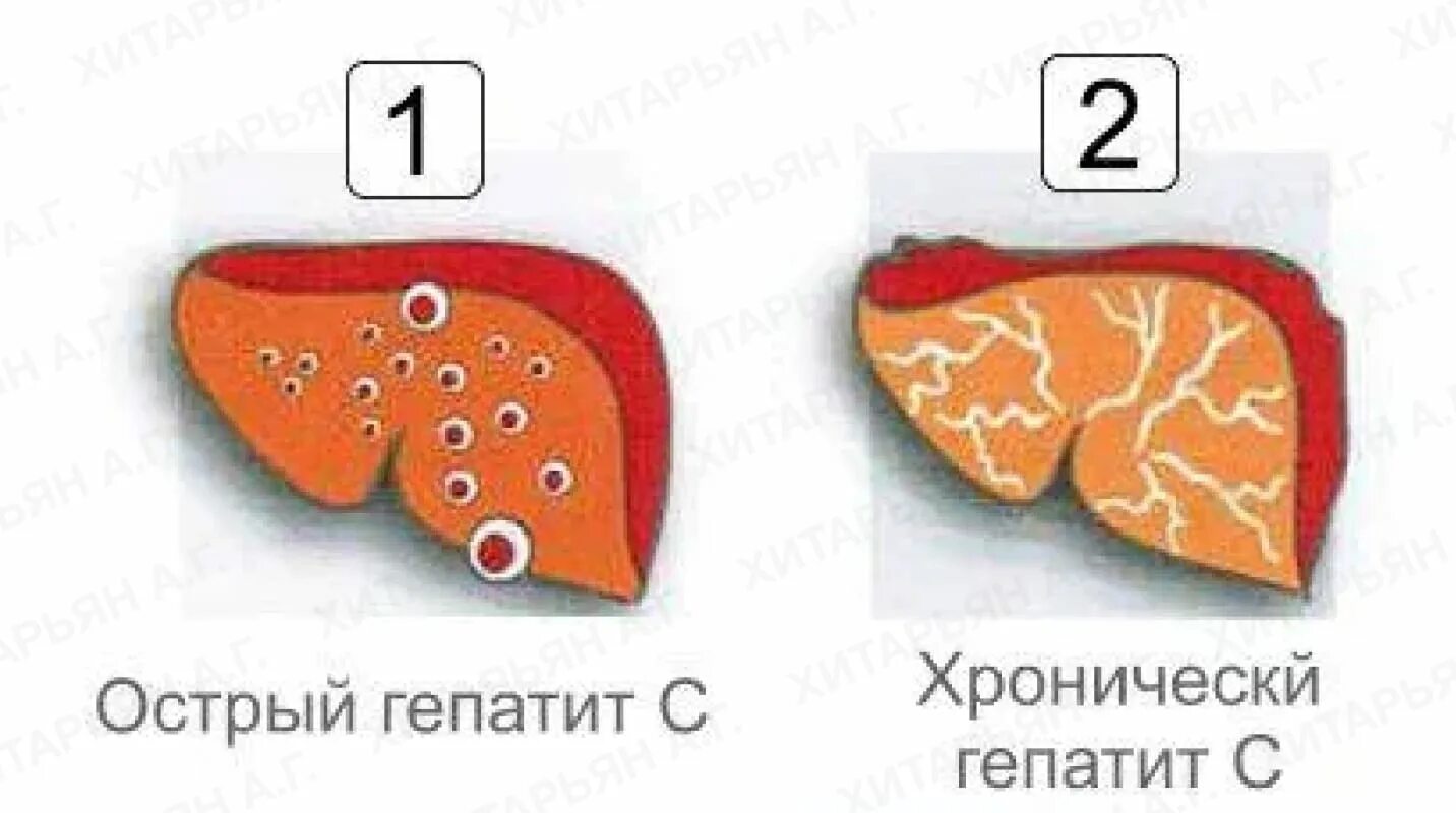 Какой кал при печени