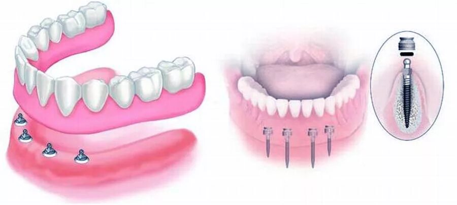 Протез нижней челюсти на 4 имплантах. Имплант челюсти на 4 штифтах. Несъемные зубные протезы на 4 имплантах.