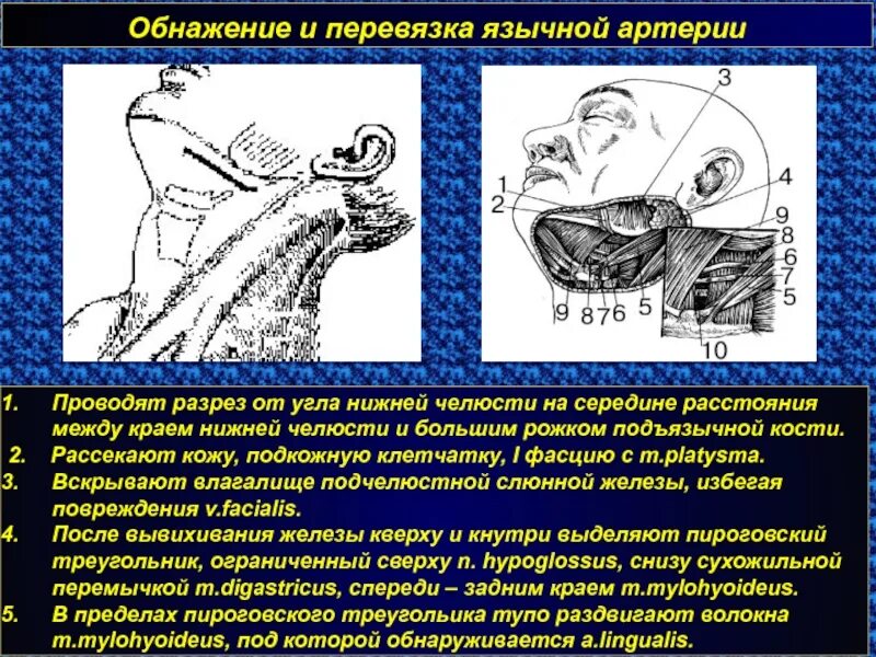 Операция на артерии шеи. Перевязка лицевой артерии. Доступ к язычной артерии. Операция перевязки язычной артерии. Перевязка язычной артерии техника.