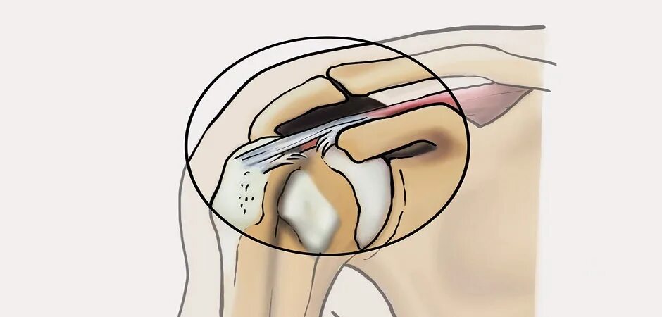 Разрыв надостной мышцы лечение. Частичное повреждение сухожилия надостной мышцы плечевого сустава. Растяжение сухожилий надостной мышцы. Разрыв сухожилия подостной мышцы. Частичный разрыв сухожилия надостной мышцы.