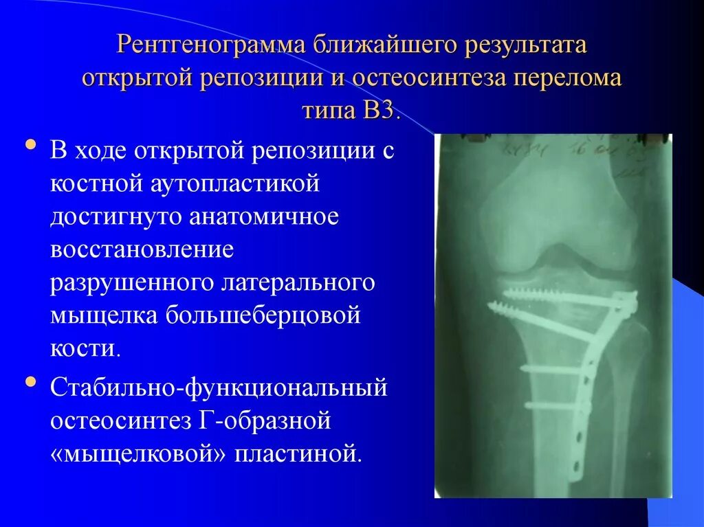 Остеосинтез мыщелков. Остеосинтез большеберцовой кости пластиной. Остеосинтез мыщелка большеберцовой. Перелом большеберцовой кости остеосинтез. Остеосинтез мыщелка большеберцовой кости.