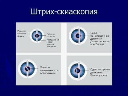 Скиаскопия это