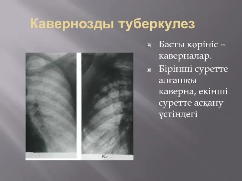 Туберкулез слайд. Штампованные каверны туберкулез. Штампованные каверны характерны для туберкулеза. Туберкулезная каверна. Саркоидоз презентация фтизиатрия.