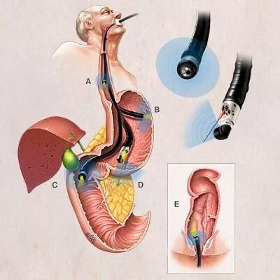 Эндосонография(ЭНДОУЗИ). Эндоскопическая ультрасонография пищевода. Эндоскопическая ультрасонография (ЭУС). Эндоскопическая ультрасонография хронический панкреатит. Эус желудка
