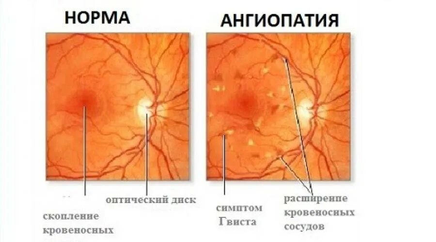 Ангиопатия глазного дна. Гипертоническая ретинопатия осложнения. Диабетическая ретинопатия сетчатки глаза. Микроангиопатия сосудов сетчатки.