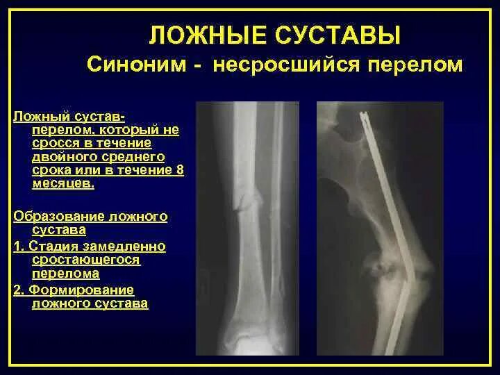 Псевдоартроз большеберцовой кости рентген. Ложный сустав большеберцовой кости. Ложный сустав бедренной кости. Ложный сустав в лучезапястном суставе.