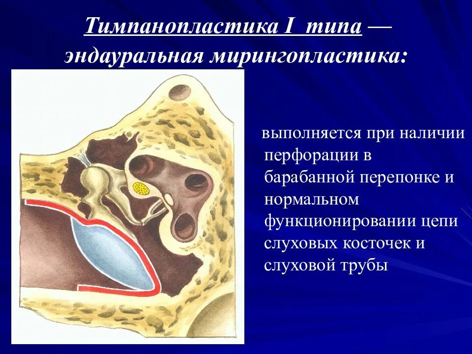 Операция на среднем ухе. Отосклероз барабанная перепонка. Тимпанопластика барабанной перепонки уха. Хронический отит операция тимпанопластика. Тимпанопластика миринготомия.