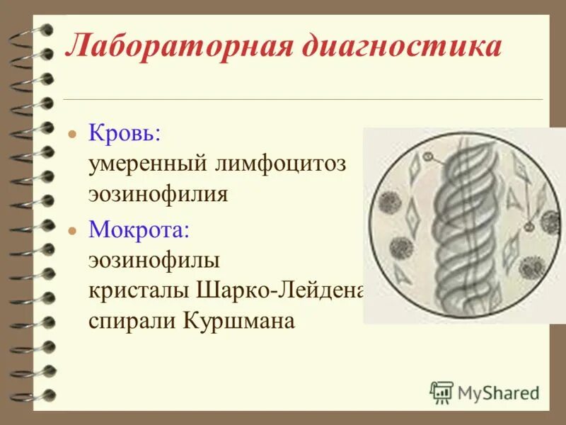 Шарко лейдена в кале. Спирали Куршмана и Кристаллы Шарко-Лейдена. Спирали Куршмана, Кристаллы Шарко-Лейдена, эозинофилы. Спирали Шарко Лейдена и спирали Куршмана. Спирали Куршмана, Кристаллы Шарко-Лейдена бронхиальной астме.