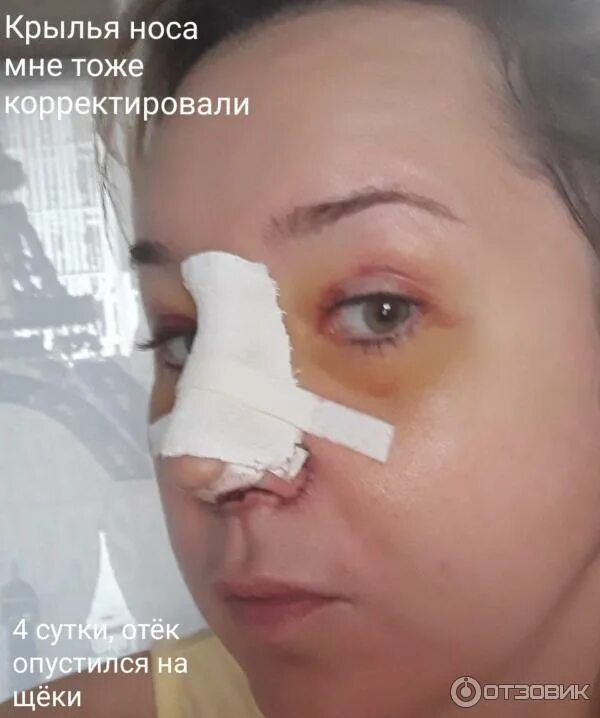 Операция носа отзывы