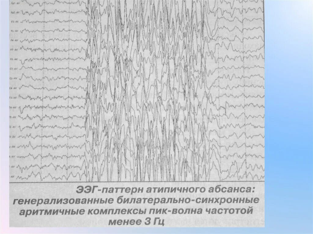 Паттерны ээг. Ээг в абсанс. абсансная эпилепсия на ээг. паттерн абсанса на ээг. генерализованные комплексы пик волна на ээг.