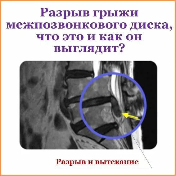 Миграция грыжи что это. Разрыв межпозвонкового диска. разрыв межпозвоночной грыжи. разрыв фиброзного кольца межпозвоночного диска.