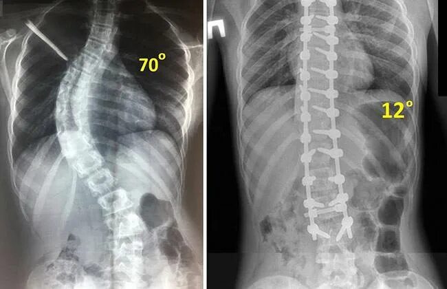 Искривление позвоночника градусы. Сколиоз 4 степени рентген. Сколиоз 2 степени рентген. Сколиоз угол искривления 17 градусов.