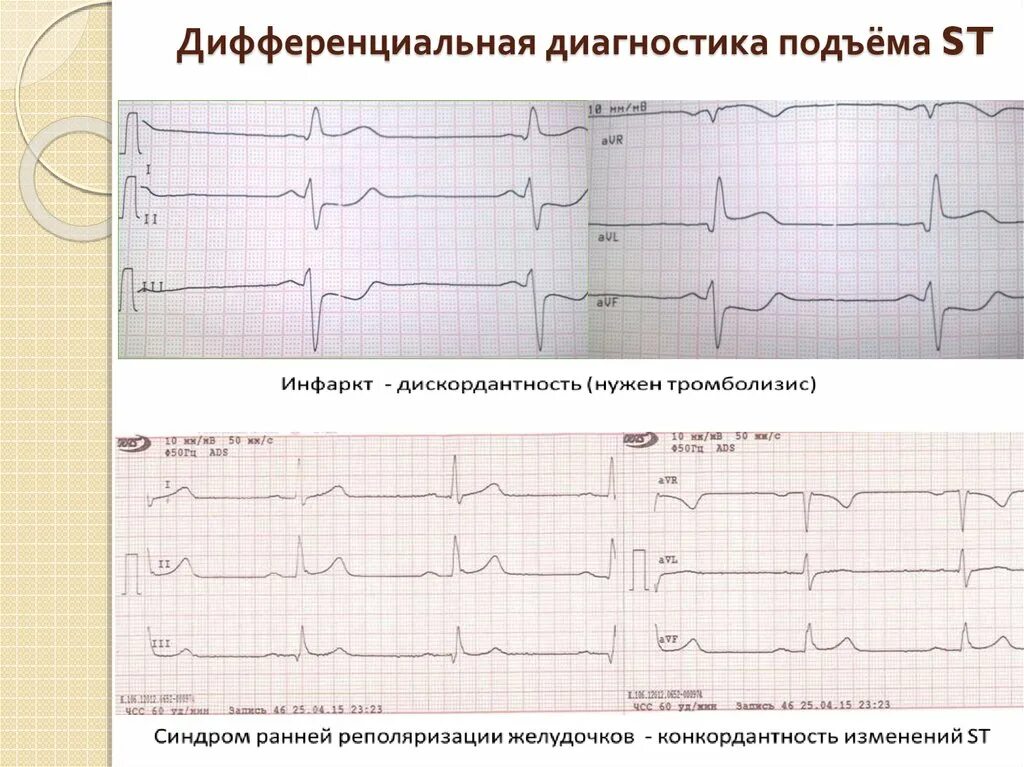 Диффузные нарушения процессов реполяризации левого желудочка. Ранняя реполяризация желудочков на ЭКГ. Изменение реполяризации на ЭКГ. Ранняя реполяризация желудочков сердца на ЭКГ. СРРЖ на ЭКГ.