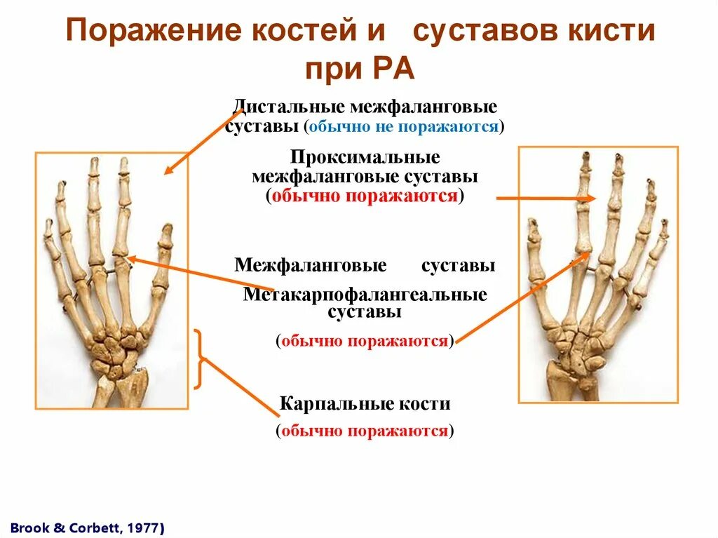 Артрит межфаланговых