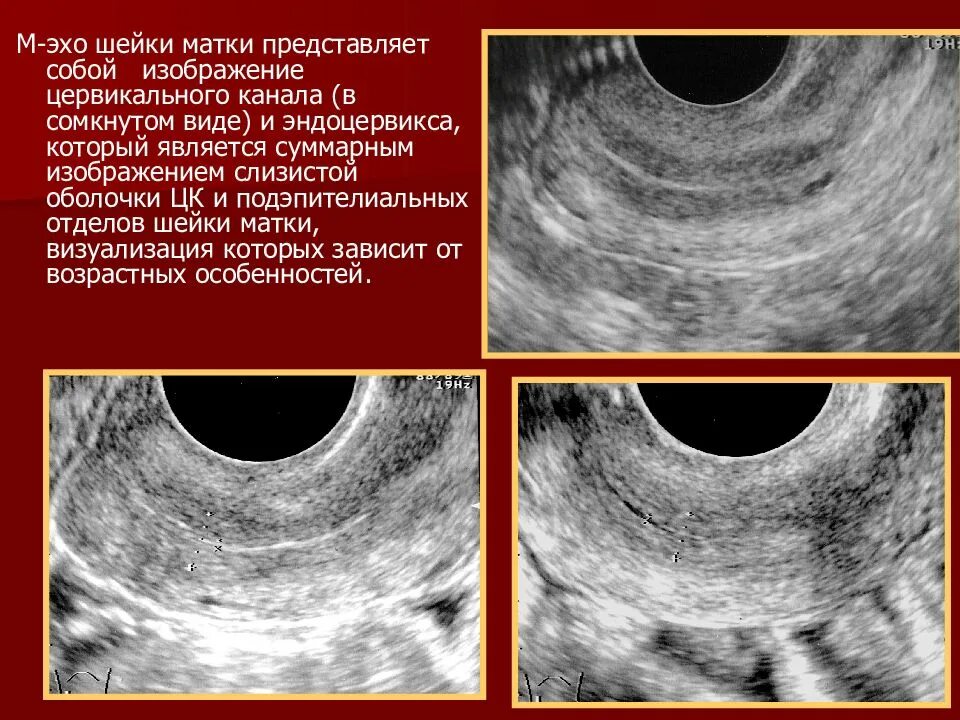 Полость матки 8. М-Эхо 14 мм линейный. М-Эхо матки.