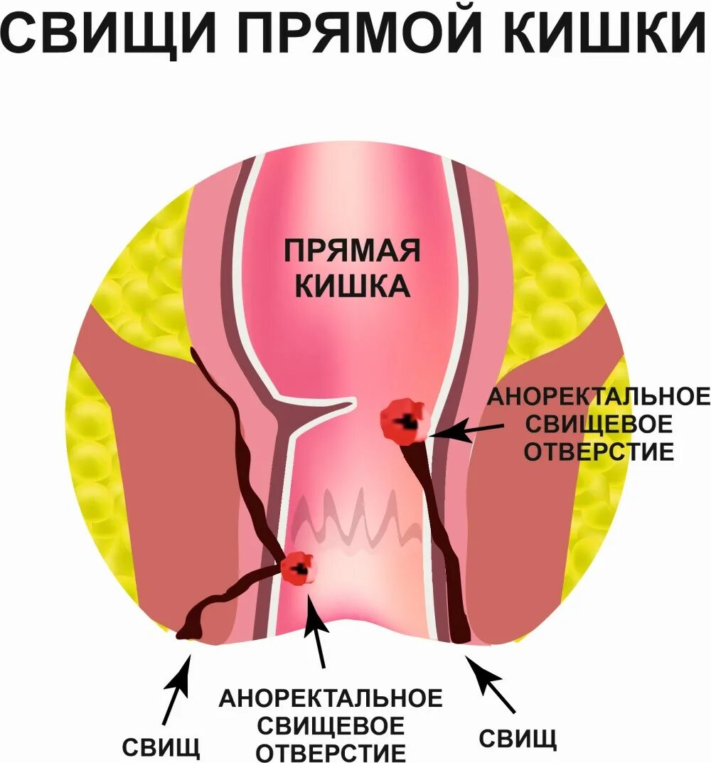 СВИЩ ПРЯМОЙ КИШКИ (ЗАДНЕГО ПРОХОДА) - koloproktolog