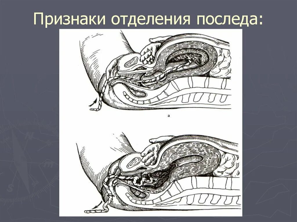 Признак отделения последа Кюстнера-Чукалова. Признаки отделения последа. Признаки отделения плаценты.