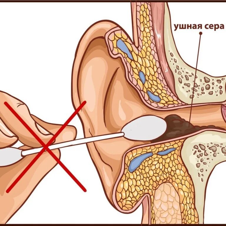 Чистка ушей ватными палочками. Строение уха и ватная палочка. Пальцы барабанные перепонки
