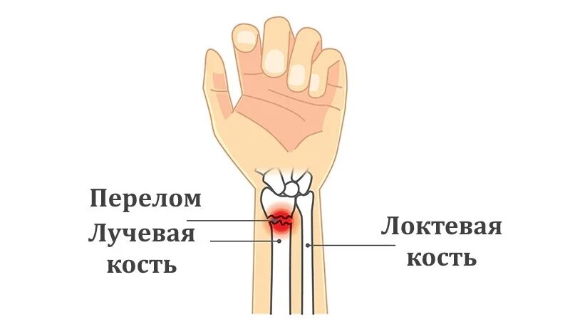 Лучевая локтевая кость на человеке. Лучевая кость на руке. Где лучевая кость на руке у человека. Шиловидный отросток лучевой кости. Лучевая кость строение строение.