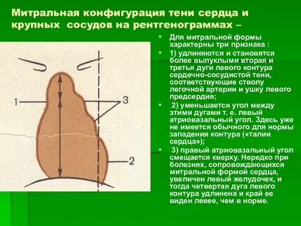 Митральное сердце