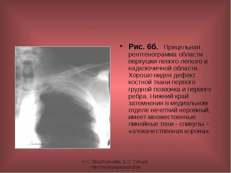 Прицельная рентгенограмма. Прицельная рентгенография легких. Прицельная рентгенография левого легкого. Прицельная рентгенография верхушек легких.