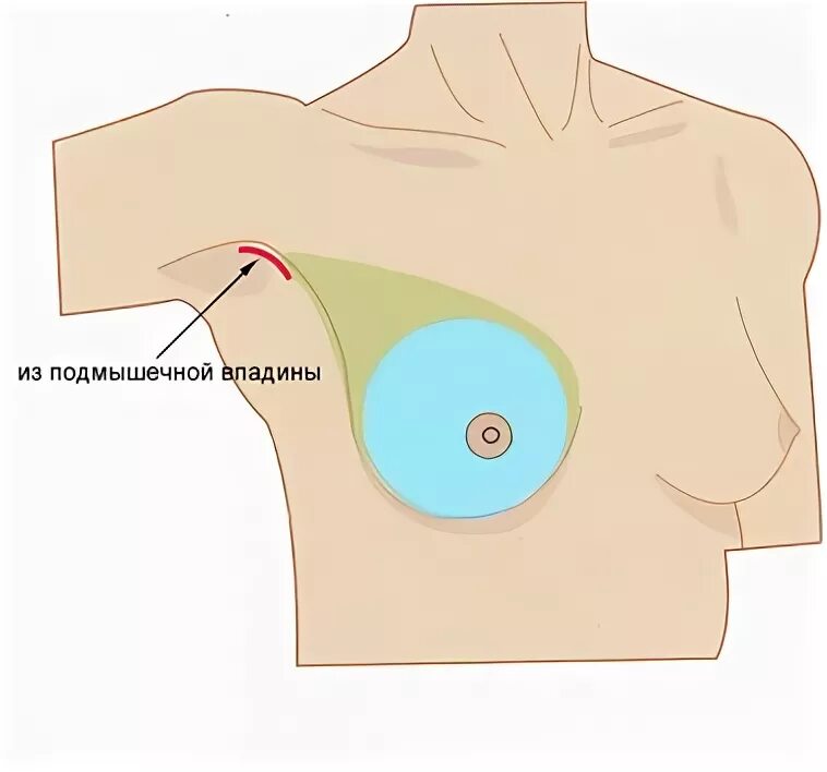 Доле груди. Молочной железы, подмышечной впадины. Добавочная долька молочной железы. Добавочные доли молочных желез в подмышечных впадинах.