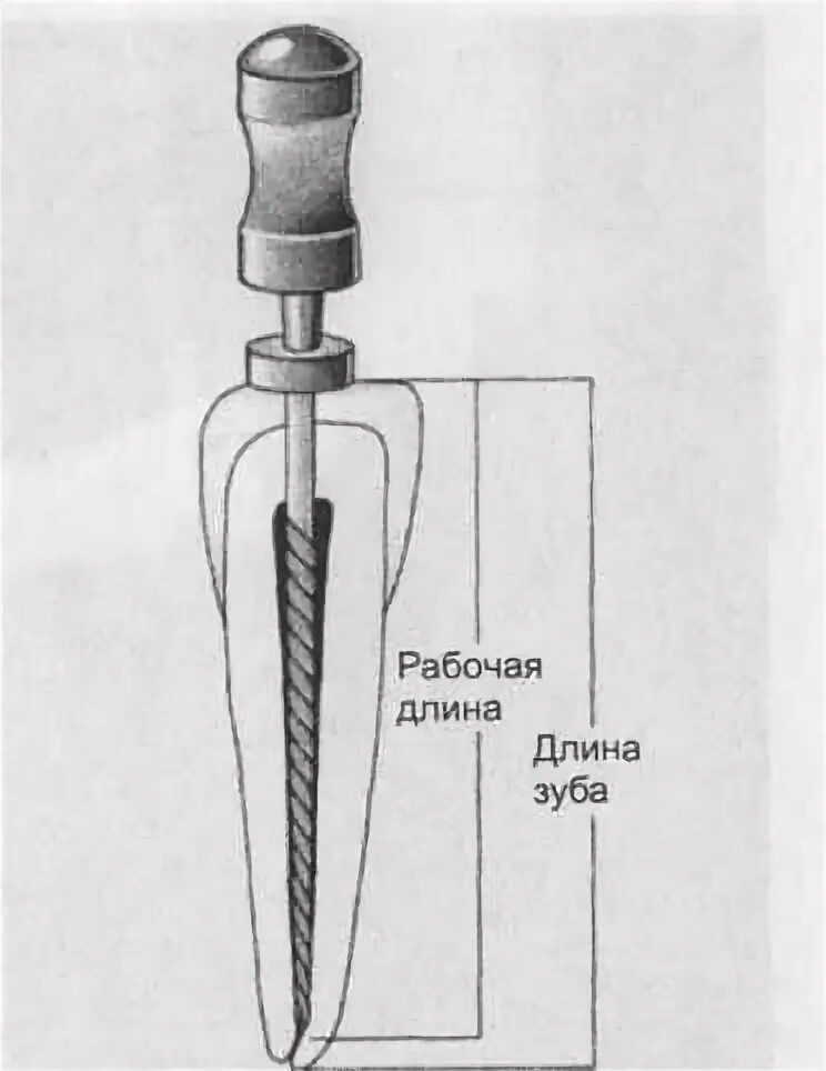 Определение рабочей длины корневого канала. Анатомический метод определения рабочей длины корневого канала. рабочая длина корневого канала. рабочая длина зуба эндодонтия. рабочая длина корневого канала определяется.