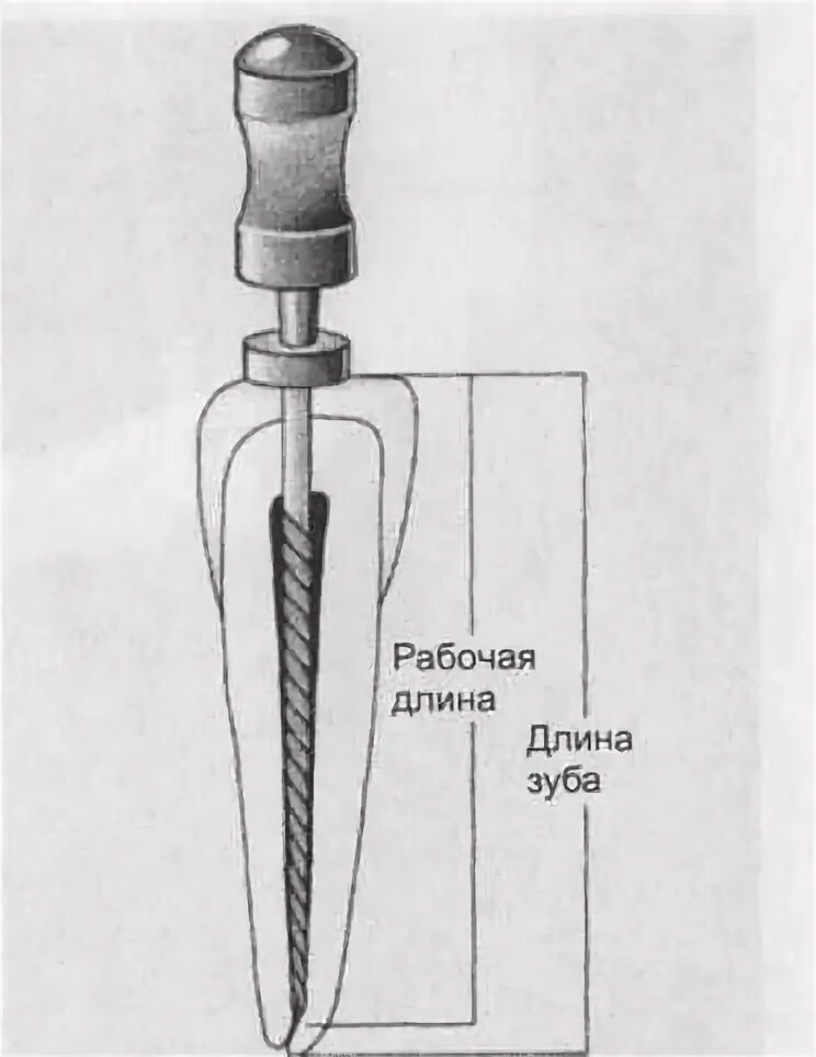 Определение корневых каналов. Анатомический метод определения длины корневого канала. Измерение рабочей длины корневого канала. Рабочая длина корневого канала определяется. Тактильный метод определения длины корневого канала.