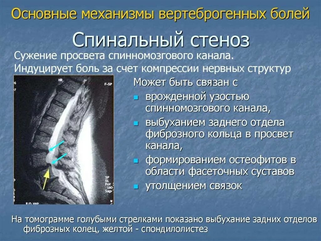 Канал без причины. Стеноз позвоночного канала l2-l3. Абсолютный стеноз позвоночного канала на кт. Стеноза костного позвоночного канала. Степени стеноза позвоночного канала поясничного отдела мрт.