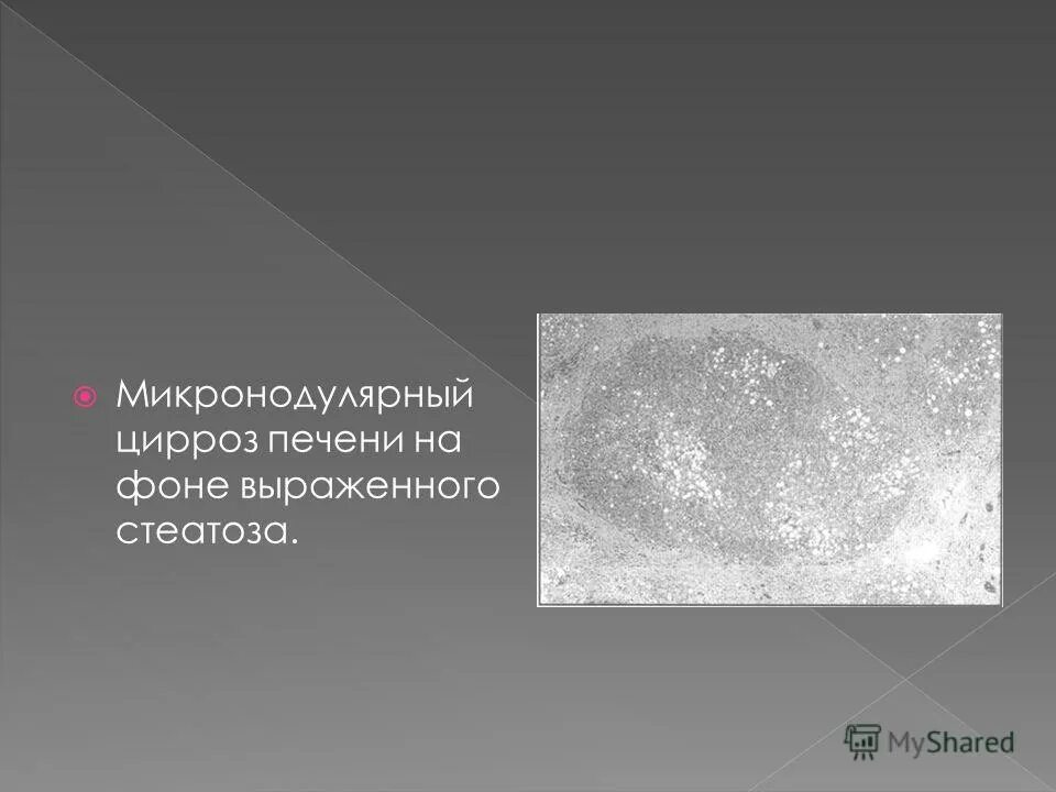 макронодулярный цирроз печени микро. микроданулярный цирроз. мелкоузловой цирроз печени макропрепарат патанатомия. макронодуодулярный цирроз печени. мелкоузелковый цирроз печени.
