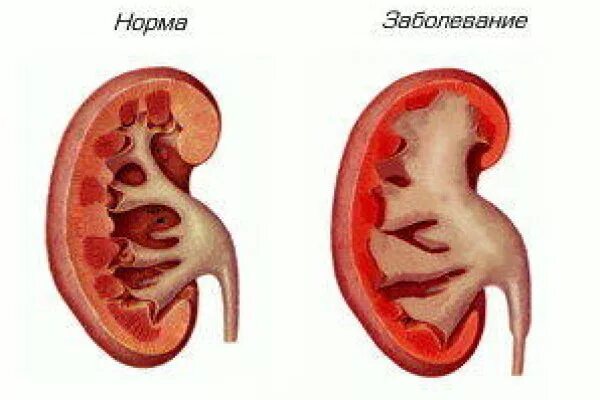 Заболевание почек гидронефроз