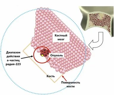 Лечение радием 223