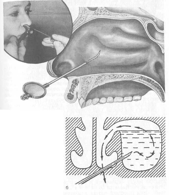 Слизистые оболочки носовых ходов. Дренирование гайморовой пазухи. Пункция гайморовой пазухи операция. Пункция гайморита пазух. Пункция верхнечелюстной пазухи.